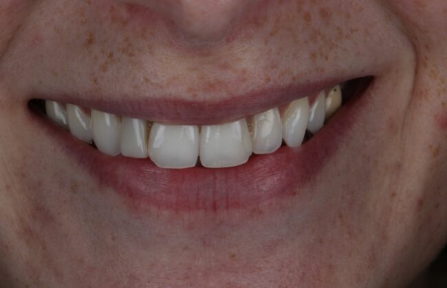 After (Teeth)
