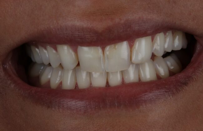 Before (Teeth)