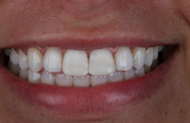 After (Teeth)