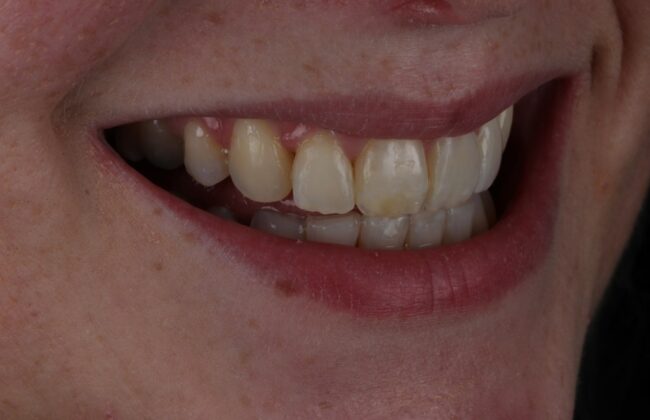 After (Teeth)