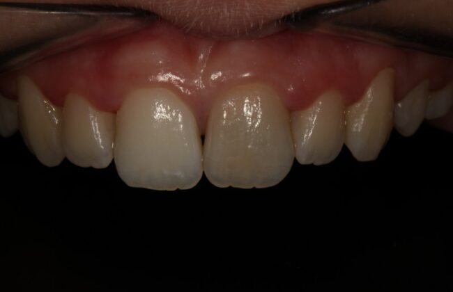 Before (Teeth)