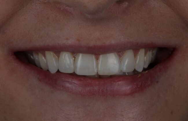 After (Teeth)