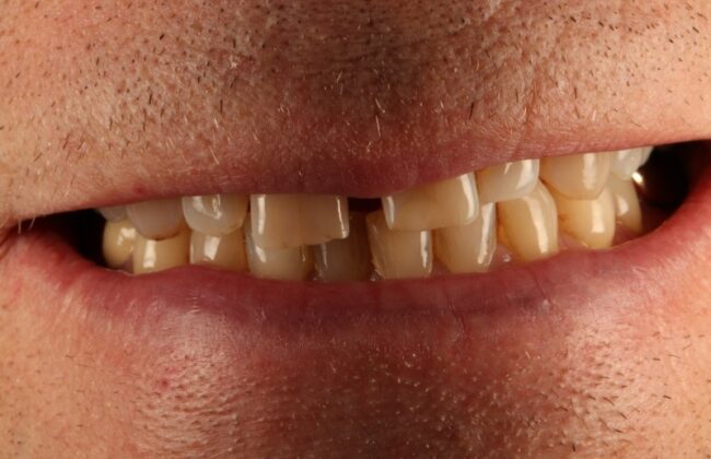 Before (Teeth)