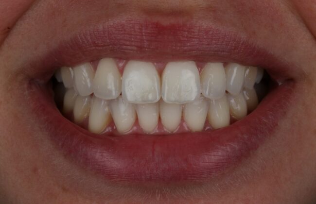 After (Teeth)