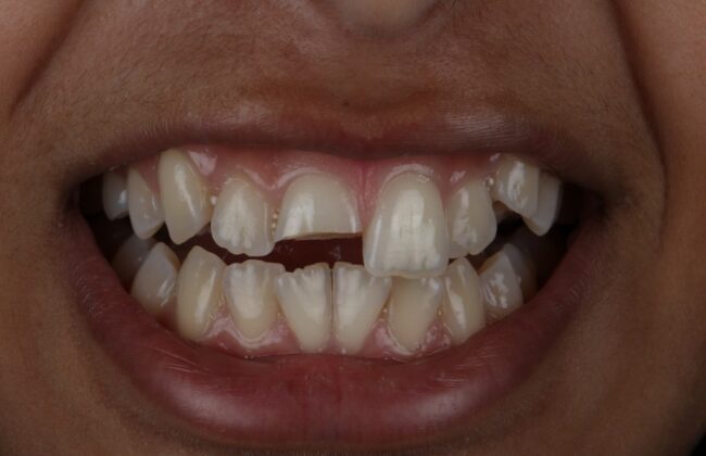 Before (Teeth)
