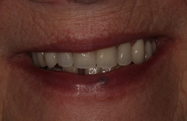 After (Teeth)