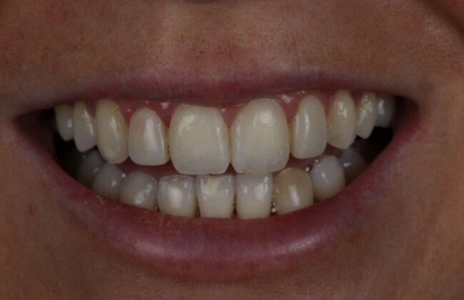 After (Teeth)