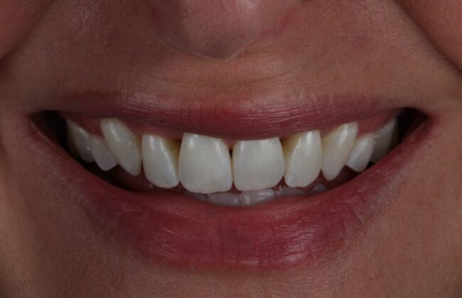 After (Teeth)