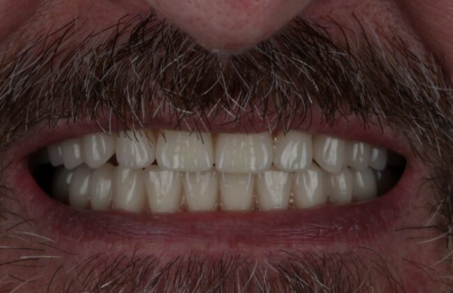 After (Teeth)