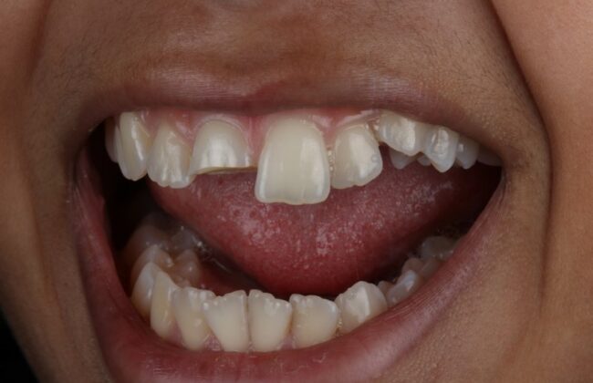 Before (Teeth)