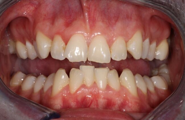 Before (Teeth)