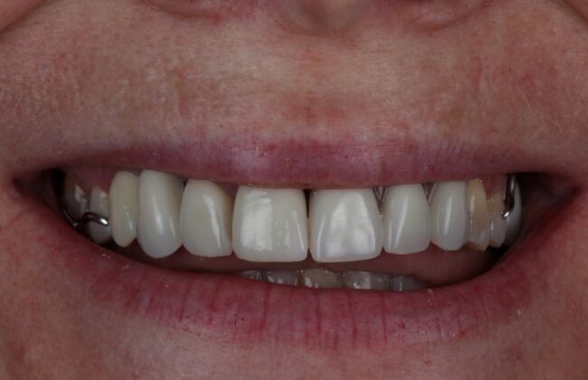 After (Teeth)