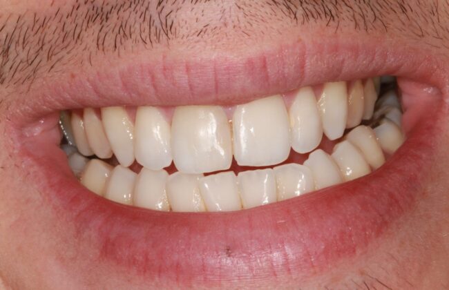 After (Teeth)