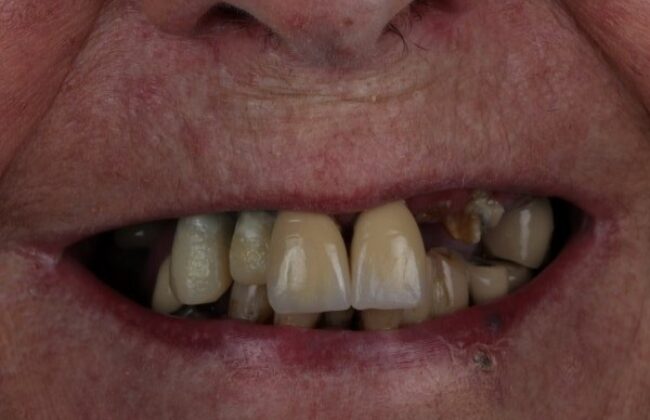 Before (Teeth)