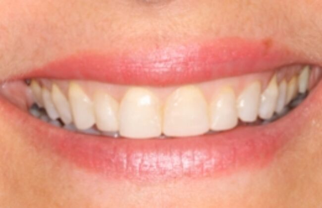 After (Teeth)