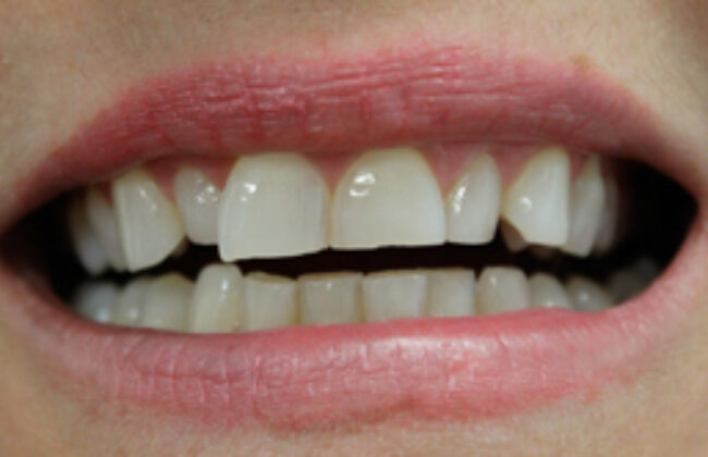 Before (Teeth)