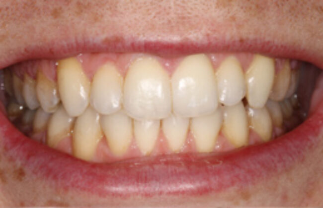 After (Teeth)