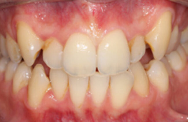 Before (Teeth)