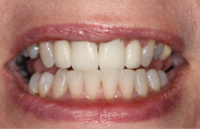 After (Teeth)