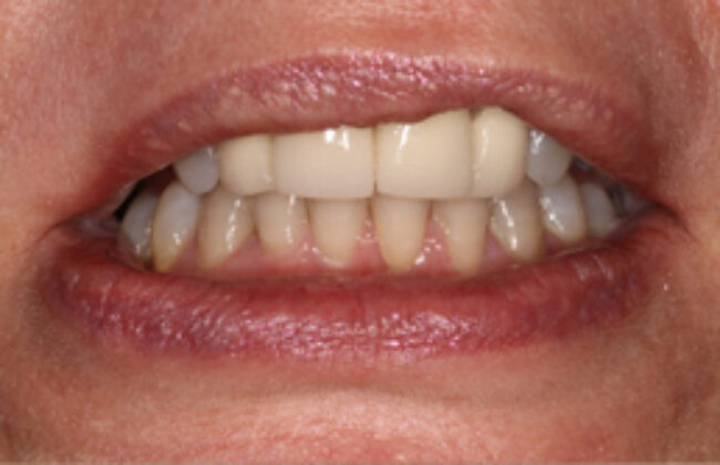 Before (Teeth)