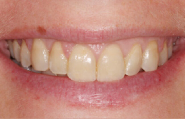 After (Teeth)