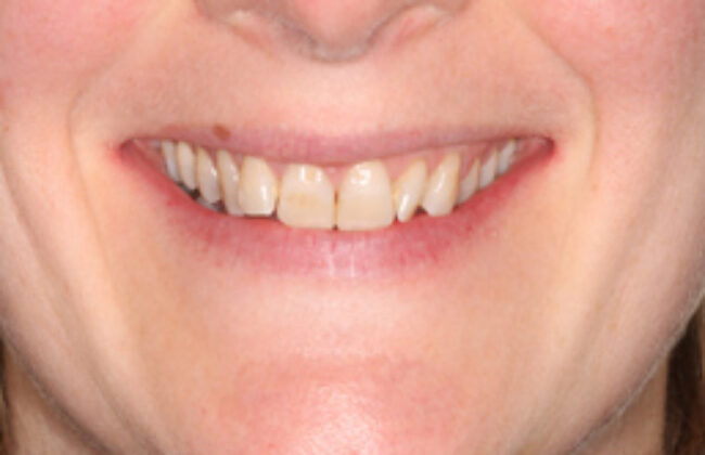 Before (Teeth)