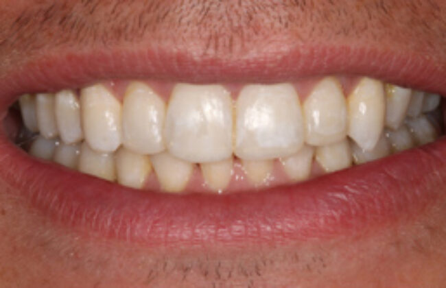 After (Teeth)
