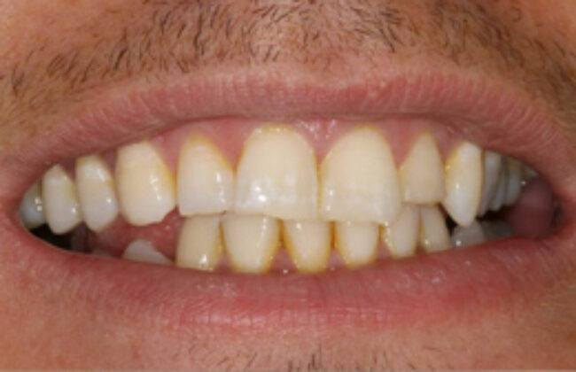 Before (Teeth)