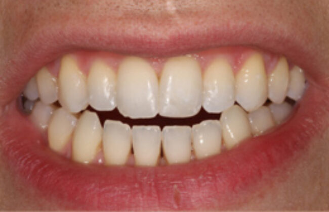 After (Teeth)