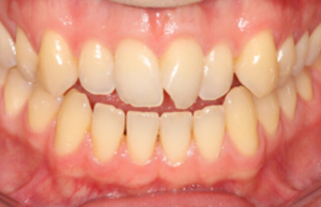 Before (Teeth)