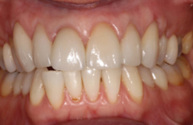 After (Teeth)