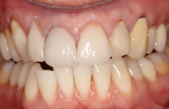 Before (Teeth)