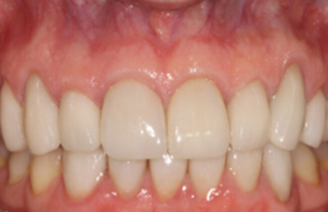 After (Teeth)