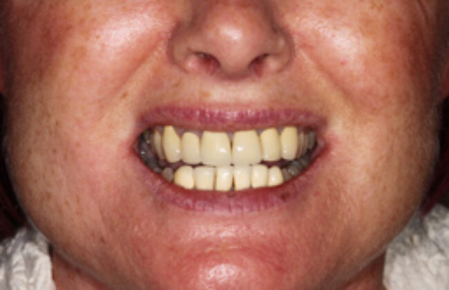 Before (Teeth)
