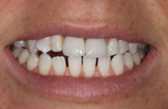 After (Teeth)