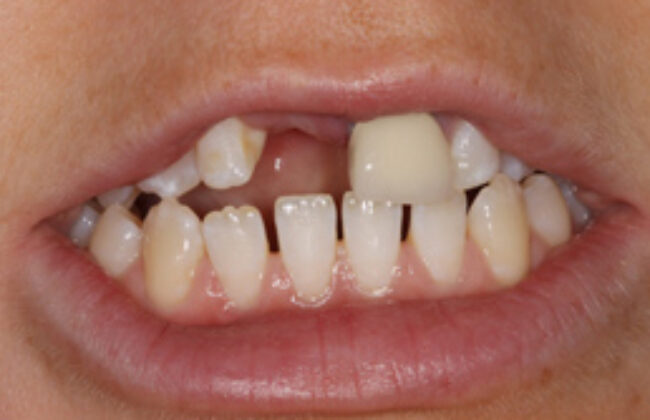 Before (Teeth)