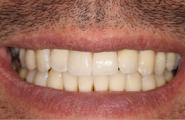 After (Teeth)