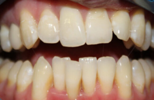 Before (Teeth)