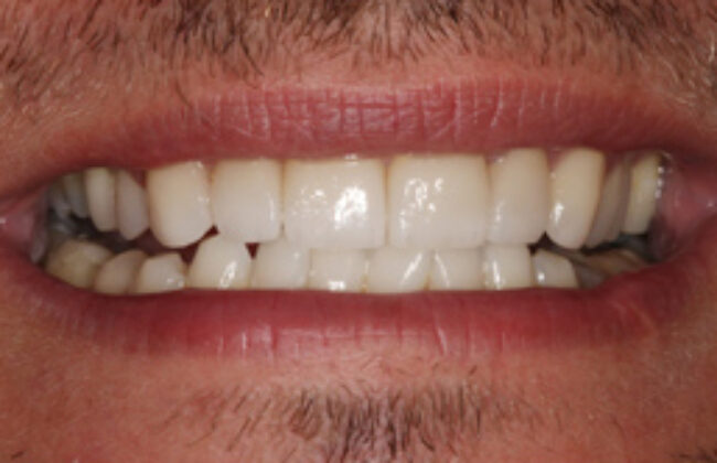 After (Teeth)