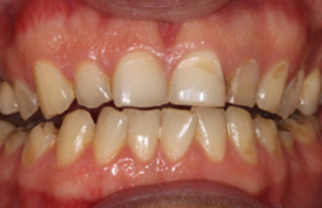 Before (Teeth)