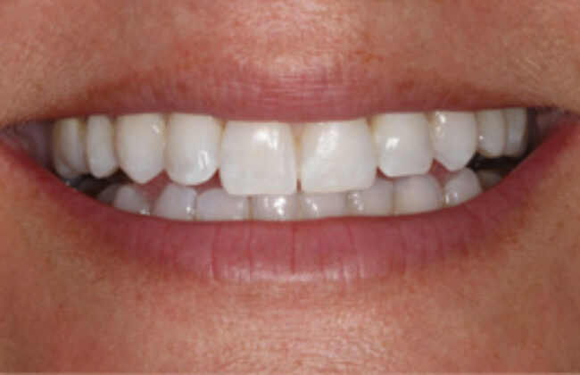 After (Teeth)