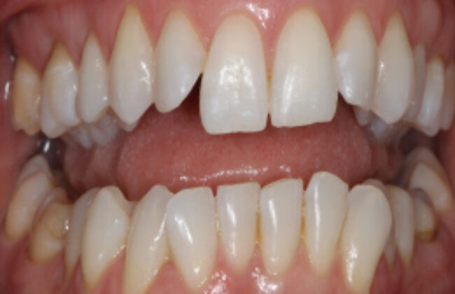 Before (Teeth)
