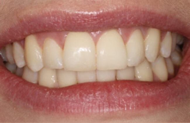 After (Teeth)