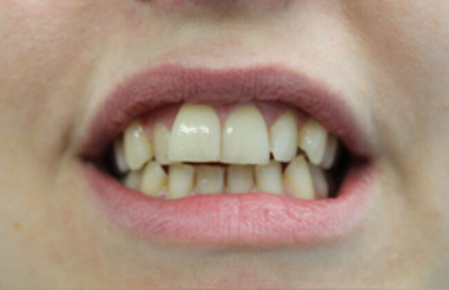 Before (Teeth)