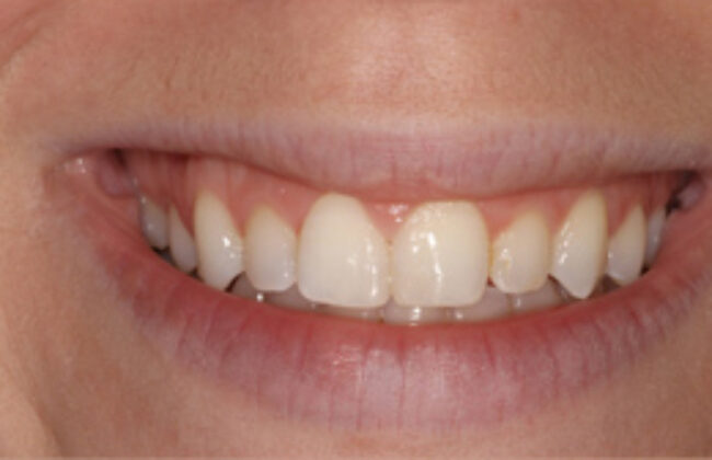 After (Teeth)