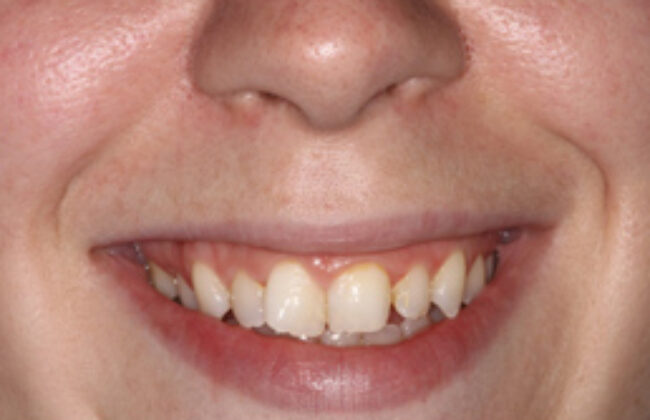 Before (Teeth)