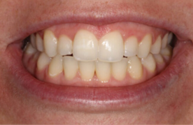 After (Teeth)