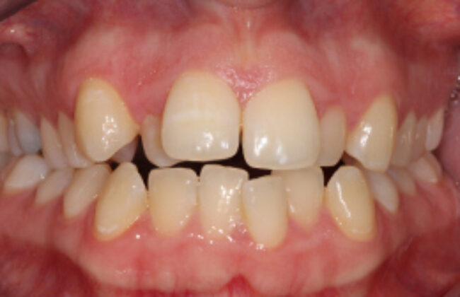 Before (Teeth)