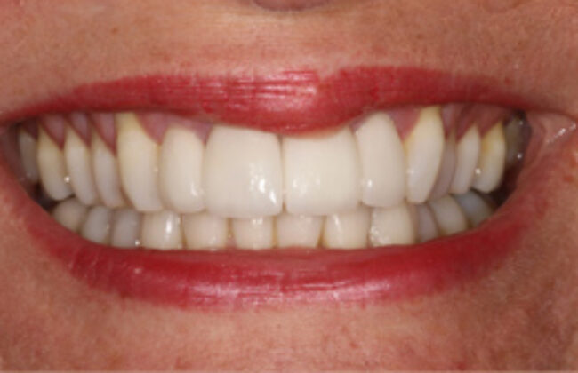 After (Teeth)