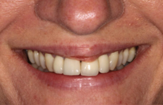 Before (Teeth)